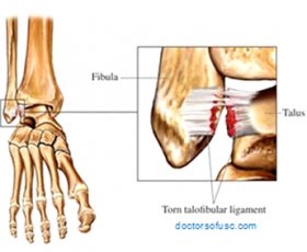 Ankle Injury Treatment & Prevention